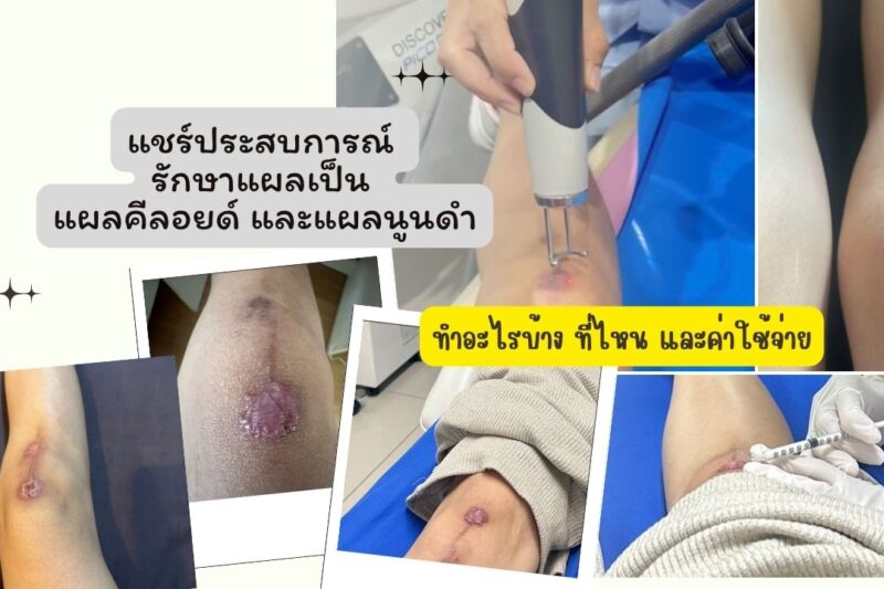 รักษาแผลเป็น เป็นคีลอยด์ทำยังไงถึงจะหาย คลินิกเลเซอร์แผลเป็น ลบรอยแผลเป็น